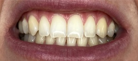 Отбеливание зубов ZOOM Томск Дамбовая как замаскировать отсутствие переднего зуба